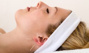 Βελονισμός Αδυνάτισμα Αθήνα